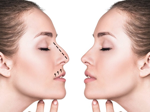 rinoplastia vs rinomodelacion